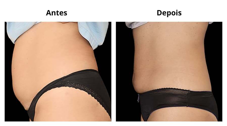 EMSculpt antes e depois 6